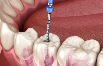 RCT : Root Canal Treatment