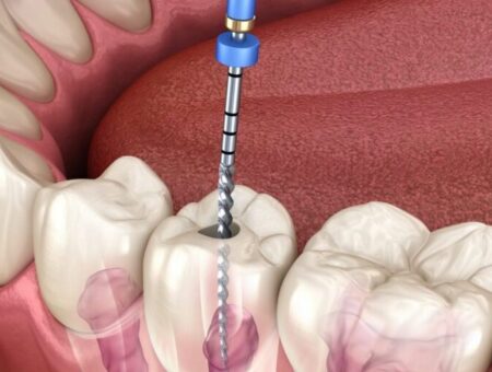 Root-Canal-Treatment-1440x720.jpg