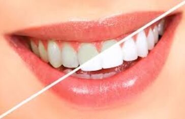 Tooth Bleaching