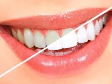 Teeth Whitening