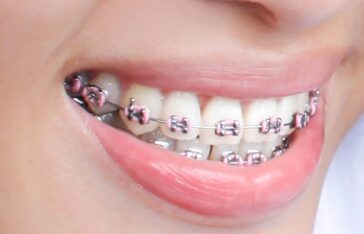 DENTOLE Orthodontics (Braces)