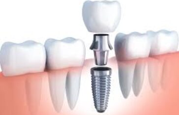 Dental Implants